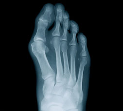 Foot X-ray with Bunions