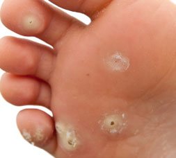 Foot with Plantar Warts