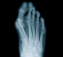 Foot X-ray with Bunions